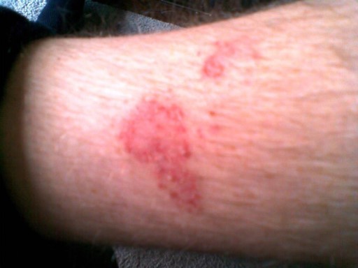 Skin Rashes